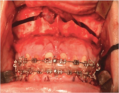 The woman underwent a LeFort I osteotomy with horizontal maxillary advancement. Images courtesy of Vasconcelos et al. Licensed by CC BY 4.0.