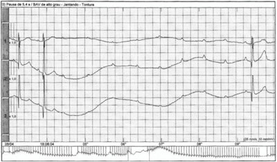 An electrocardiogram revealed that the woman's symptoms were related to the presence of a 5.4-second pause due to a high-grade block.