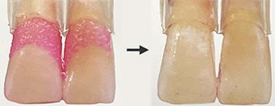 Left: Biofilms grown on human teeth and stained pink for visibility. Right: Teeth scrubbed almost entirely clean by the microbots. Image courtesy of Minjun Oh.