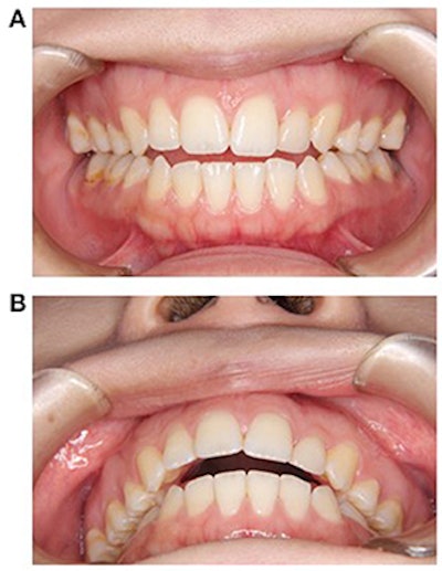 (A) Front view of the patient's open bite. (B) Occlusal view of the patient's open bite. Images courtesy of Nagamine et al. Licensed by CC BY 4.0.