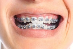 2020 07 20 14 01 0427 Braces2 400
