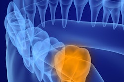 2021 11 02 15 10 3200 Wisdom Tooth 400