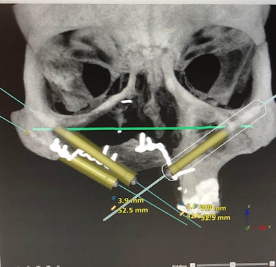 Imaging was used to help treatment plan the placement of Taylor's zygomatic implants.
