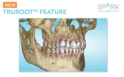 Spark Clear aligners release 13 features TruRoot, which uses CBCT scans to replace library roots in the software with a patient's actual root shape. Image courtesy of Spark aligners.