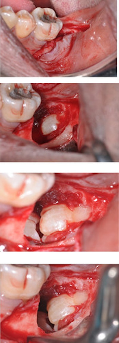 Clinical images taken during surgical removal of the patient's kissing molars.