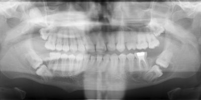 A panoramic x-ray revealed the patient's bilateral kissing molars. Image courtesy of Carr et al. Licensed by CC BY 4.0.
