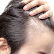 2022 11 23 17 34 5275 Hair Loss Man 400