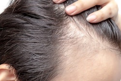 2022 11 23 17 34 5275 Hair Loss Man 400