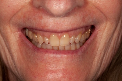 Preop full smile before whitening. Shade D4/D3. All images courtesy of Dr. Kevin Brown.
