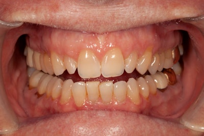 Preop retracted view before whitening.
