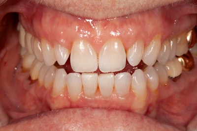 Preop retracted view after the Philips Zoom! WhiteSpeed in-office treatments.