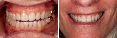 Postop retracted view after direct composite bonding and postop full smile view.