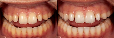 Preop retracted view before whitening. Preop retracted view after one week of Philips Zoom! Take-Home DayWhite 14% Hydrogen Peroxide.