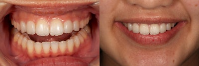 Postop retracted view after direct composite bonding and postop full smile view.