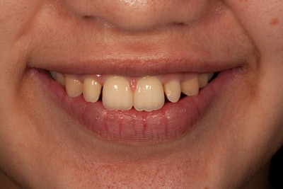 Preop full smile view before whitening.