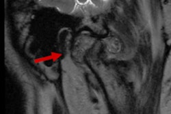 2023 01 11 23 21 5444 2023 01 12 Tmj Trismus Case Report Fig 2 400