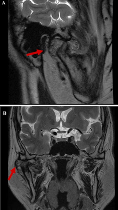 The patient's preoperative MRI images. (A) Sagittal T1-weighted sequence of the right TMJ shows a fluid-filled mass expanding within the joint space, as well as multiple loose bodies. (B) A coronal proton density-weighted sequence shows a heterogeneous signal intensity tissue mass within the capsule of the right TMJ between the right glenoid fossa and the mandibular condyle (red arrow).