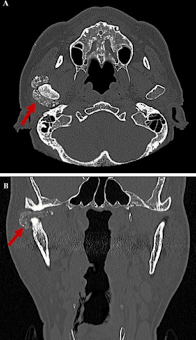 The patient's preoperative CT images. (A) The axial view shows large intra-articular localized calcified lesions that abut the articular surface of the mandibular condyle of the right TMJ. (B) The coronal view of the right TMJ indicates partial attachment of the calcified mass to the superior aspect of the mandibular condyle and cranial base.