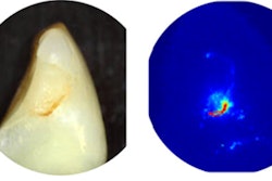 2023 01 12 23 03 7567 2023 01 13 Imaging Caries 400
