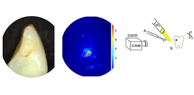 When shortwave-infrared imaging is combined with air drying, it can be used to detect dental caries. Since cavities are porous and hold more water, infrared measurements around the decay changes as the tooth dries. Image courtesy of Dr. Nai-Yuan Chang et al of the University of California, San Francisco.