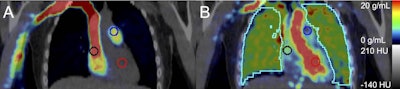 Representative fused coronal PET/computed tomography images after injecting 207 MBq fluorine-18 nitric oxide synthase with 2 cm diameter spherical blood pool search volumes of interest in the right atrium (black), pulmonary artery (blue), and left ventricle (red), with (A) PET-summed uptake 0-15 seconds post injection and (B) PET-summed 37 to 42 seconds post injection with lung volume of interest (cyan). Image and caption courtesy of the Journal of Nuclear Medicine through CC BY 4.0.