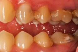 2017 07 07 13 34 02 577 Teeth Periodontal Disease 400