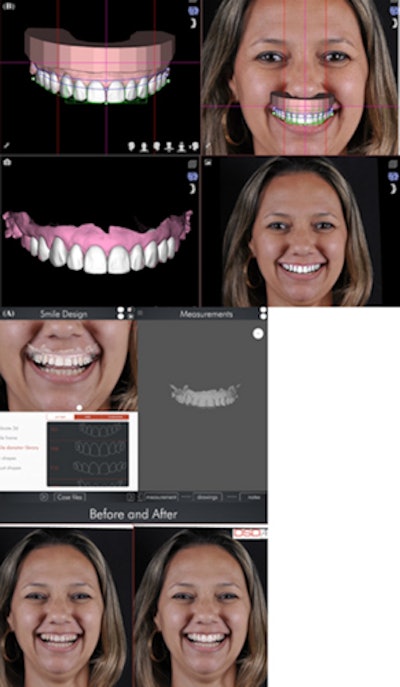 Intraoral photos and digital documentation of the patient that were used for treatment planning. Images courtesy of Bohner et al. Licensed by CC BY 4.0.