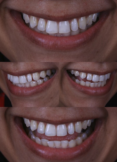 The image shows the try-in of the digital wax-up. After periodontal surgery, the shells were placed in the patient's mouth to determine final adjustments before the teeth preparation.