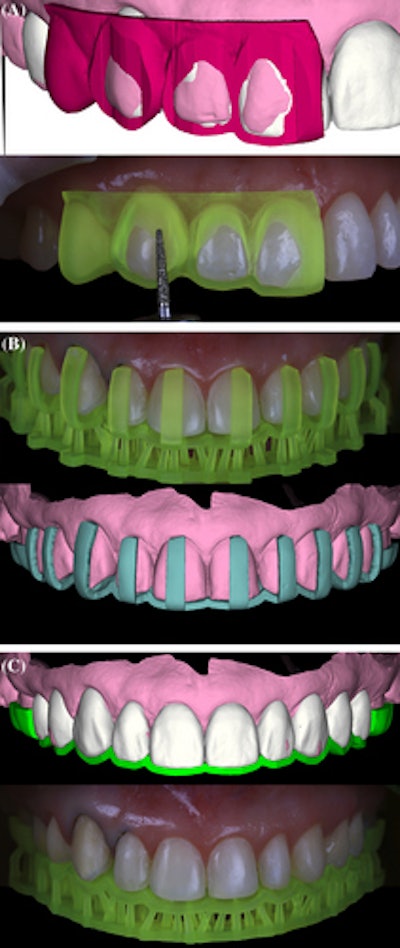 Preparation guides, which were designed digitally and placed in the mouth, were used to control the preparation procedure (A) and to control the labial (B) and incisal (C) reduction.