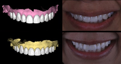 The digital workflow. Upper left: digital wax-up; upper right: postsurgical mock-up; lower left: digitally designed ceramic restorations; lower right: final ceramic restorations. The workflow reproduced a form and texture that show a predictable, lifelike result.