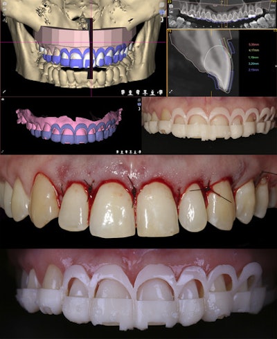 For periodontal surgical planning, linear measurements showing the relationship between hard and soft tissues were performed. 1. The distance between the current gingival margin and the cement-enamel junction (2.15 mm). 2. The distance between the cementoenamel junction and bone (3.20 mm). 3. Distance between the current and the ideal gingival margin (1.18 mm). 4. Distance between the current gingival margin and bone (5.35 mm). 5. Distance between the ideal gingival margin and bone (4.17 mm). Also, clinicians designed and printed a crown-lengthening guide to steer the periodontal surgery.