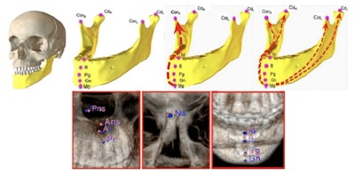 A deep-learning model analyzed CT images to reveal the spatial relationships between key anatomical landmarks of craniomaxillofacial bones. Image courtesy of Torodagli et al.
