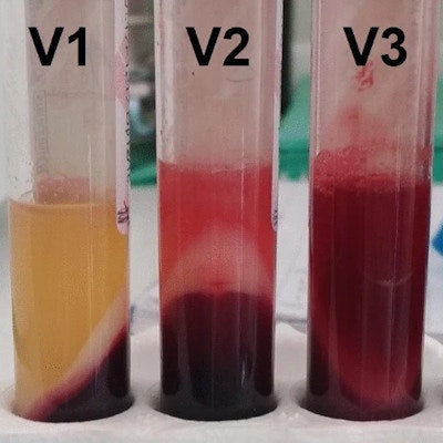 2023 03 15 16 19 8438 2023 03 15 Vancomycin Interference 400