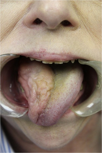 The woman's tongue shows right-sided atrophy and mild right-sided deviation. Image courtesy of Scott et al. Licensed by CC BY 4.0.