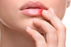 2023 03 23 22 08 5627 Mouth Sore Woman 400