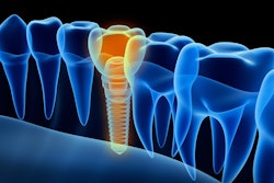 Implant 3 D