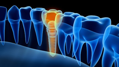 Implant 3 D