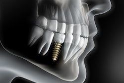Implant 3 D2