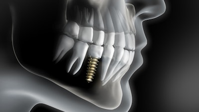 Implant 3 D2