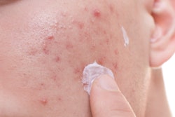 Young Man Acne Cream