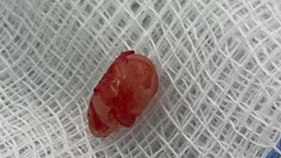 The mesiodens following removal via a maxillary vestibular transnasal approach.