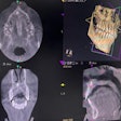 A CBCT scan shows the teen’s nasally impacted tooth.