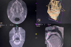 A CBCT scan shows the teen’s nasally impacted tooth.
