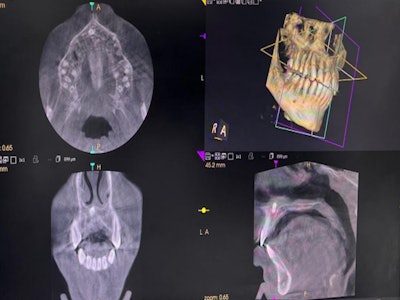 A CBCT scan shows the teen’s nasally impacted tooth.