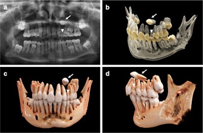 An 11-year-old girl with a horizontally impacted canine (white arrows) and a persisting deciduous canine (white arrowheads). (a) An x-ray of the girl’s mouth. (b) Semitransparent reconstruction parameters are used to visualize bone, teeth, and different dental tissues. (c and d) The teeth and bone tissue with a soft kernel show a photorealistic visualization in both a frontal and lateral view.
