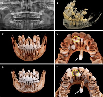 An 11-year-old boy with a mesiodens and a supplementary tooth (white arrows) within the hard palate. (a) An x-ray of the boy’s mouth. (b) A display of the semitransparent reconstruction parameters. (c and d) The bone reconstruction parameters with a soft kernel can lead to artifacts in regions with teeth near each other (yellow circle in d, e, and f.) The same situation is shown with a hard kernel, allowing better differentiation between the roots of the mesiodens and of tooth #21 (yellow circle in f).