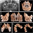 A 12-year-old boy with cleidocranial dysostosis and multiple supernumerary and impacted teeth. (a) An x-ray of the boy’s mouth. (b-e) Bone present, with a soft kernel in the frontal, lateral, and palatal views. (c-e) Tooth #11 (the blue arrowhead), tooth #21 (the green arrowhead), and tooth #13 (the yellow arrowhead) are displayed along with their respective supernumerary teeth #11 (blue arrow), #21 (green arrow), and #13 (yellow arrow).
