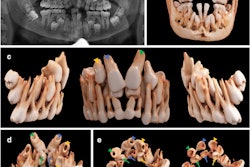 A 12-year-old boy with cleidocranial dysostosis and multiple supernumerary and impacted teeth. (a) An x-ray of the boy’s mouth. (b-e) Bone present, with a soft kernel in the frontal, lateral, and palatal views. (c-e) Tooth #11 (the blue arrowhead), tooth #21 (the green arrowhead), and tooth #13 (the yellow arrowhead) are displayed along with their respective supernumerary teeth #11 (blue arrow), #21 (green arrow), and #13 (yellow arrow).