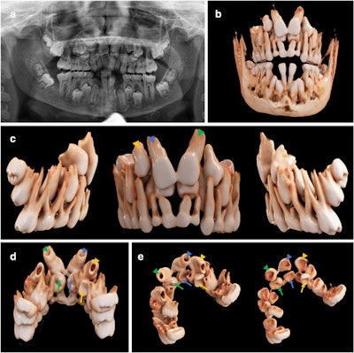 A 12-year-old boy with cleidocranial dysostosis and multiple supernumerary and impacted teeth. (a) An x-ray of the boy’s mouth. (b-e) Bone present, with a soft kernel in the frontal, lateral, and palatal views. (c-e) Tooth #11 (the blue arrowhead), tooth #21 (the green arrowhead), and tooth #13 (the yellow arrowhead) are displayed along with their respective supernumerary teeth #11 (blue arrow), #21 (green arrow), and #13 (yellow arrow).