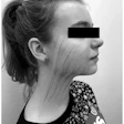 The taping method used on one of the third-molar extraction patients.